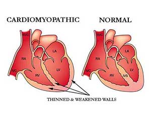 cardiomyopathic - Dr. VT Shah